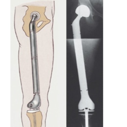 Diagram and X-Ray of Prosthesis Inserted