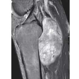Resections in the popliteal fossa and posterior compartments of leg 