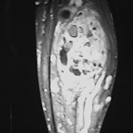 28B) Coronal MR Of Right Proximal Fibula Hemangiopericytoma