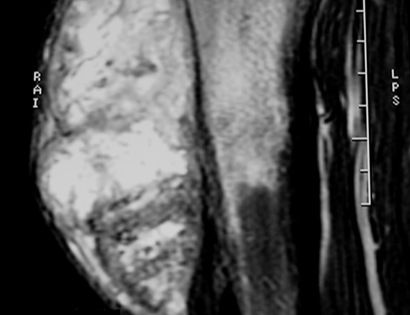 MRI of a Periosteal Osteosarcoma