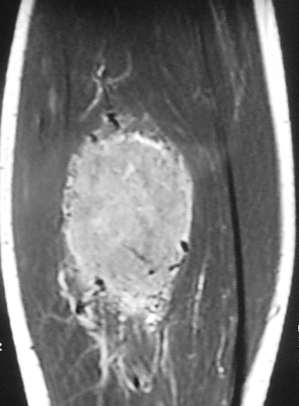 66B) Coronal T1 MRI Of Lower Leg Alveolar Soft Parts Sarcoma