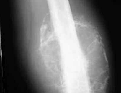Distal Femur X-ray of Tumor