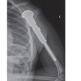 Proximal Humerus Prosthesis Replacement