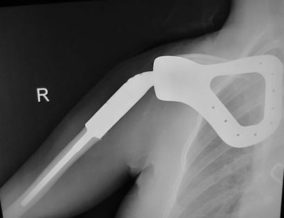 Total Scapula Replacement X-ray 
