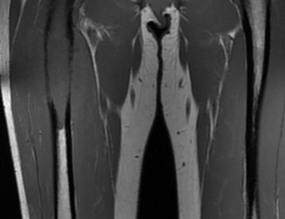 MRI photo of tumor 
