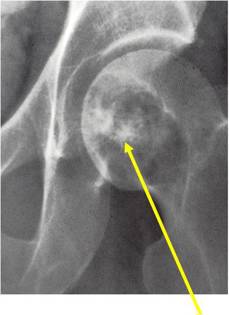 X-Ray of Clear Cell Chondrosarcoma