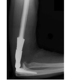 Distal Humerus and Total Elbow Prosthetic Replacement