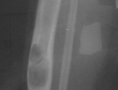 Radiographic Image of an Adamantinoma
