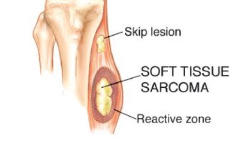 Soft Tissue Tumor 2
