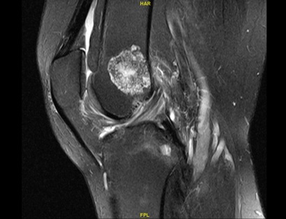 Example of MRI showing an Enchondroma
