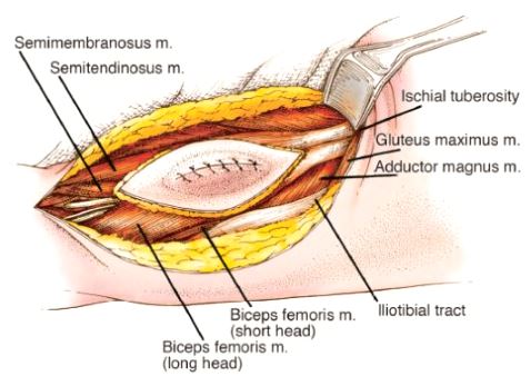 Hamstrings Dissection