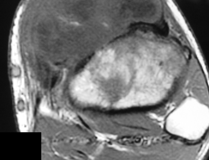 MRI of Periosteal Ostesarcoma