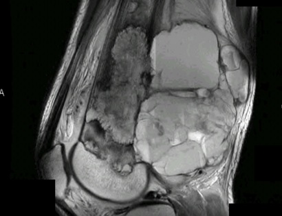 MRI of a Telangiectatic Osteosarcoma
