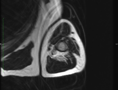 MRI of Myeloma