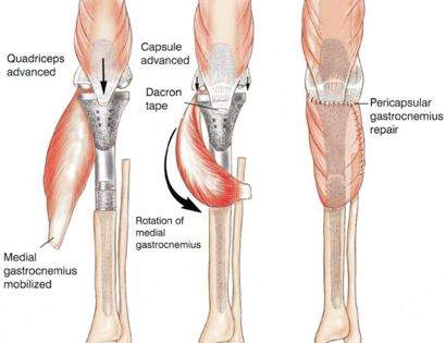 Muscle Rotation: Gastrocnemius Flap 