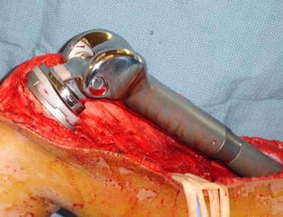 Intra-Op: Prosthesis Inserted
