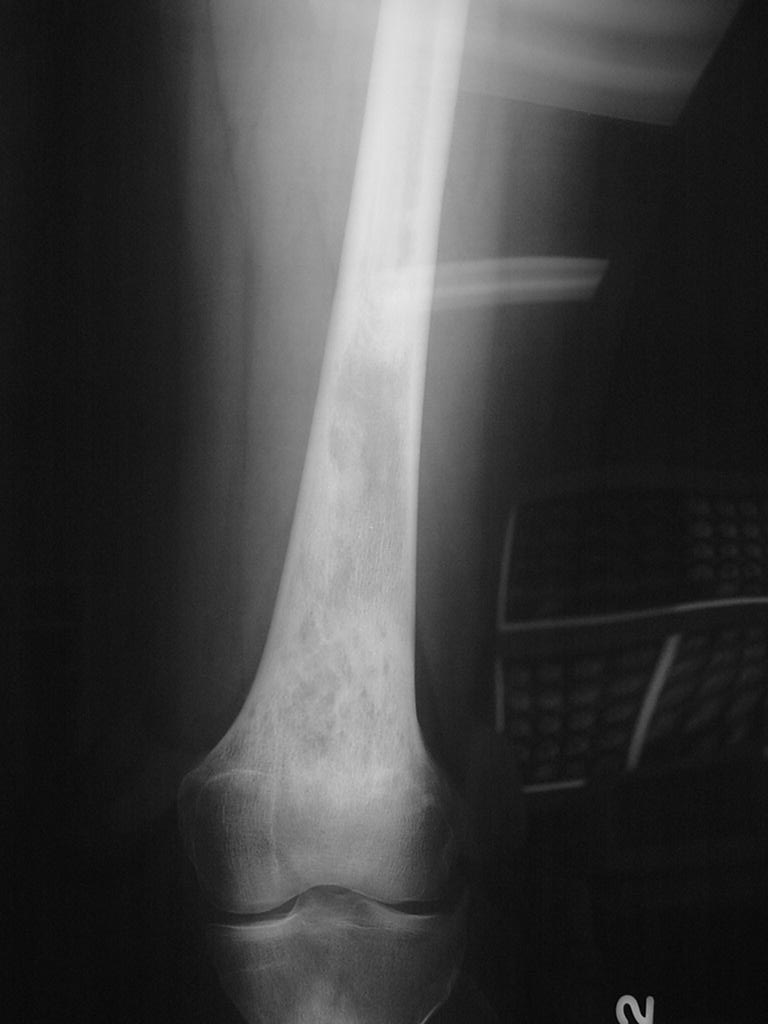 12A)Plain Radiograph Of Epithelioid Hemangioendothelioma Of Femu